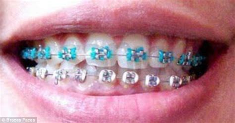 How To Make Homemade Fake Braces The Dangers Of Fake Braces Diy Braces More Accorde