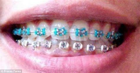 Fake Braces Trend Is A New Status Symbol For Asian Teenagers But Could They Kill Wearers