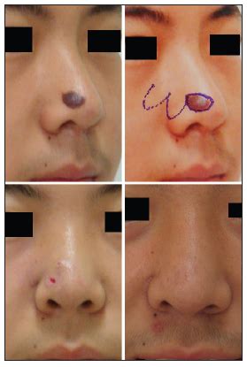 A modified bilobed flap design for nasal tip defects