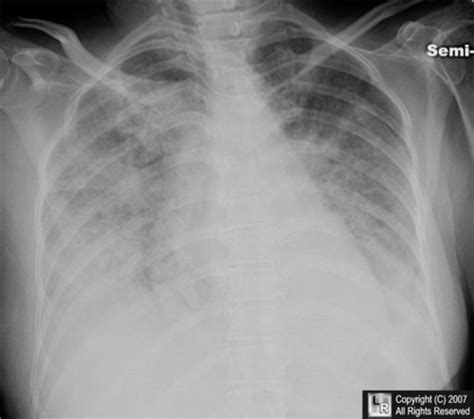Cardiogenic Pulmonary Edema Radiology Notes