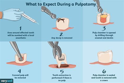 Pulpotomie Utilisations Effets Secondaires Et Procédure