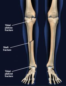 Tibial Fractures Central Coast Orthopedic Medical Group