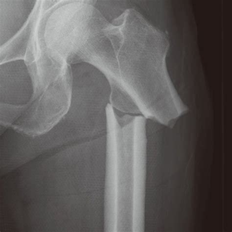 Subtrochanteric Fracture Of Femur Without Trauma In A Patient With A