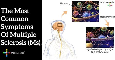 The Most Common Symptoms Of Multiple Sclerosis Ms Positivemed