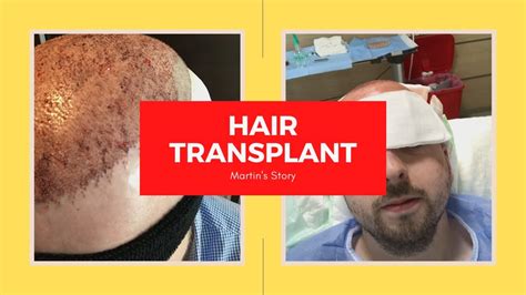 Hair Transplant Turkey Documentary Youtube
