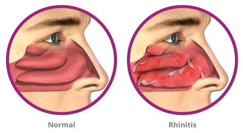 New Breakthrough In The Treatment Of Chronic Rhinitis Runny Nose — Ent And Allergy Inc