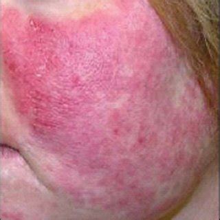 Clinical Differential Diagnosis Of Cutaneous Lupus Erythematosus My