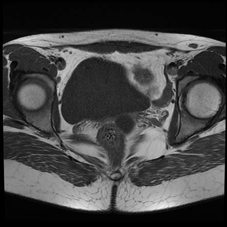 Bilateral True Hermaphroditism Radiology Case Radiopaedia Org