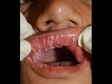 Testimonio Virus Papiloma Humano Y Tratamiento Youtube Hot Sex Picture