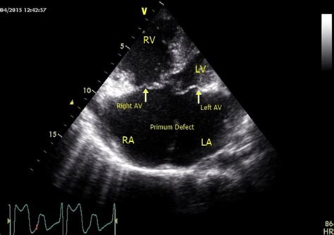Four Chamber View Of Transthoracic Echocardiography Shows A Large