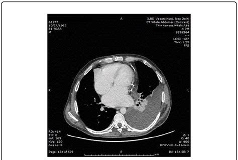 Ct Image Showing Left Pleural Effusion And Residual Pericardial Fibrous