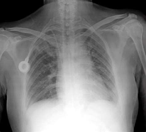 Chest X Ray Showing A Suspicious Consolidation In The Right Upper Lung