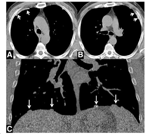 A C Pleural Plaques A B Transverse Ct Image Of The Chest Shows Smooth