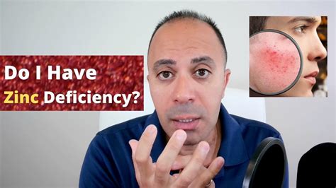 Do I Have Zinc Deficiency Causes Symptoms And Treatment Youtube