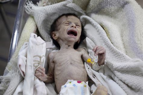 Harrowing images of starving baby reflect the agony of Syria's civil war
