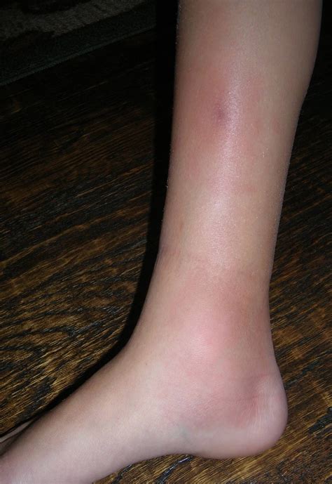 Woman S Leg With Red Lumps And Swelling From Erythema Nodosum Hospital Photography Hand