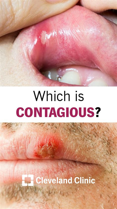 Which Is Contagious Your Canker Sore Or Cold Sore Canker Sore Cold