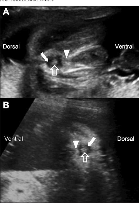 Figure 1 From Sonographic Determination Of Type In A Fetal Imperforate