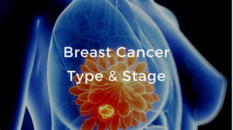 Breast Cancer Stage And Type The Breast Cancer School For Patients