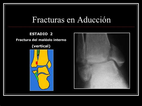 Fracturas De Tobillo