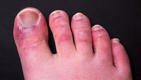 Strange Covid 19 Symptoms Affecting Peoples Fingers Toes And Even