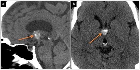 Cureus A Rare Case Of Choroid Plexus Papilloma Of The Third Ventricle