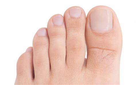 Se calcula que afectan, aproximadamente, al 3 % y 4 % de la población. Problemas más comunes en las uñas de los pies. Causas y ...
