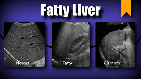 Medical Ultrasound Fatty Liver