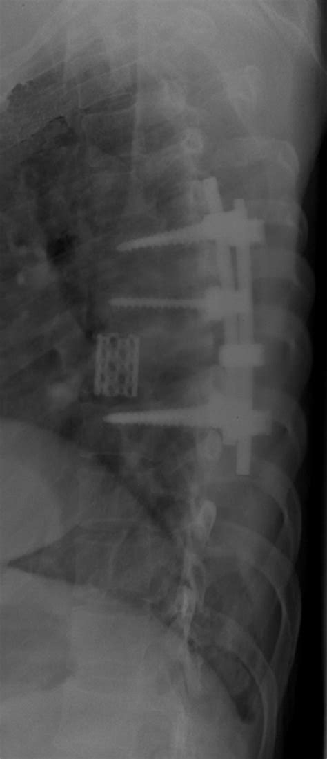Figure 1 From Treatment Of Middle Super Thoracic Fractures Associated