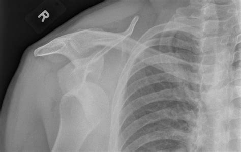 Glenohumeral Dislocation Anterior And Posterior Undergraduate