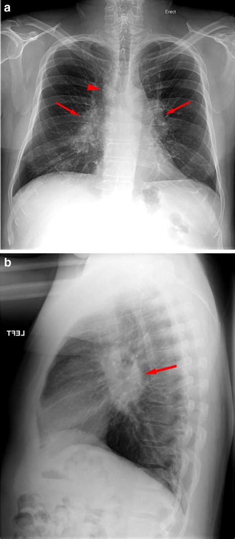 A And B In Pa Frontal Chest X Ray Mediastinal Lymphadenopathy In