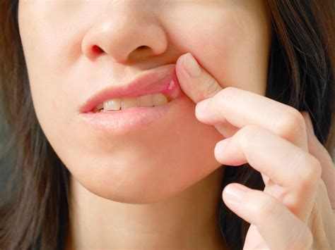 Canker Sores Causes Remedies And Prevention