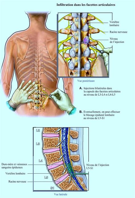 Les douleurs lombaires sont souvent causées par des muscles qui se sont affaiblis. Le syndrome de vertèbres lombaires dans le dos, la ...