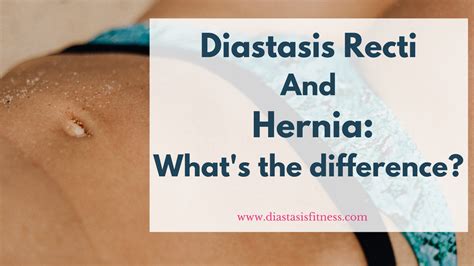 Diastasis Recti And Hernia Whats The Difference
