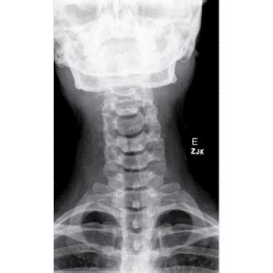 Posicionamento radiológico Coluna vertebral Cervical Anatomia