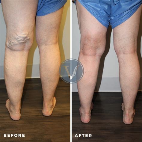 The Effective Leg Workout Exercises To Prevent Varicose Veins Or Spider Veins