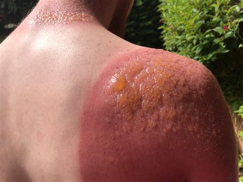 2nd Degree Burns Healing Stages Pictures Causes 53 Off