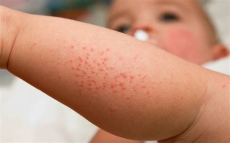 Daftar 4 Pemicu Utama Alergi Pada Anak Kenali Sebelum Terlambat