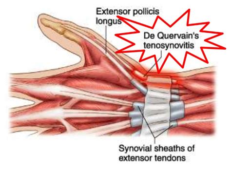 De quervain's tenosynovitis is due to excessive use of the wrist. Dequervain's Tenosynovitis - South Florida Hand Surgery