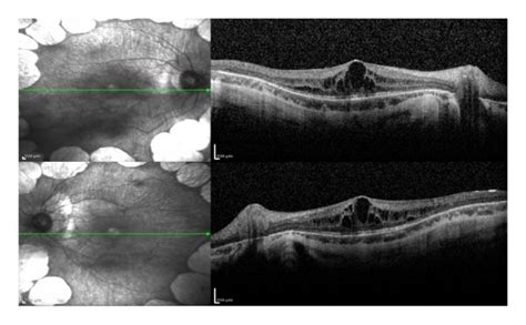 At The Time Of Diagnosis Sd Oct Revealed Bilateral Macular Edema In