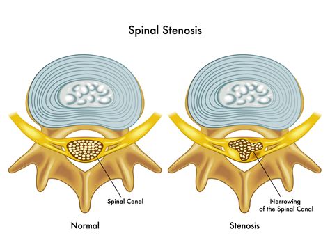 What Is Spinal Stenosis Orthopaedic Medical Group Of Tampa Bay