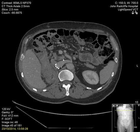 Cureus An Unusual Recurrence Of Signet Ring Cell Gastric