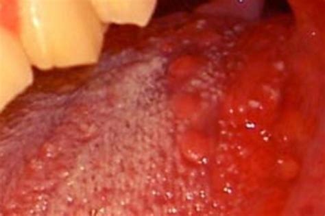 Bumps On Back Of Tongue White Large Red Lumps Std Sore