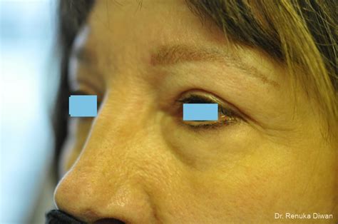 Blepharoplasty Before And After Gallery Patient 3