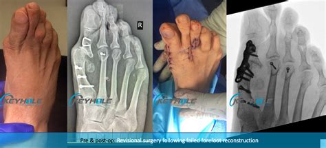 Revisional Foot Surgery Perth Podiatric Surgery