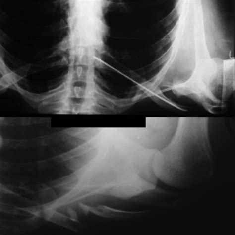 A Neer Type Iia Distal Clavicle Fracture B Open Reduction And