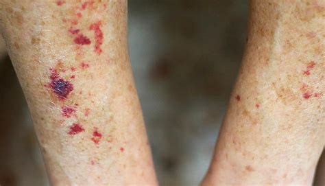 Purpura Blood Spots Thrombocytopenic Symptoms Causes