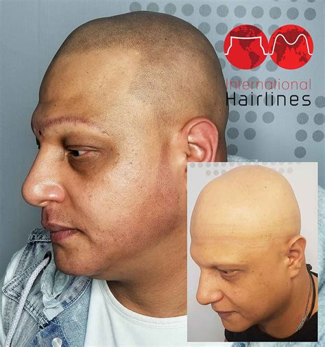 Male pattern alopecia and masculinity // brit. Scalp Micropigmentation For Alopecia Treatment ...