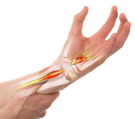 Carpal Tunnel Syndrome Treatment Ctr Procedures Iortho