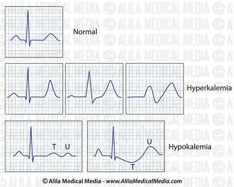 Alila Medical Media Hyperkalemia And Hypokalemia Ecg Medical The Best